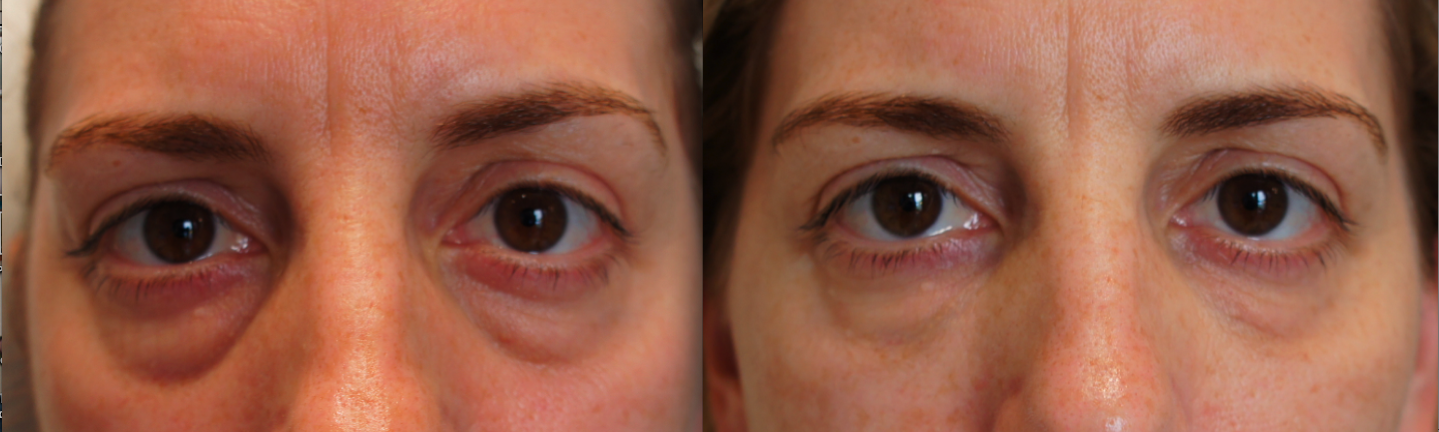 Prp before after images